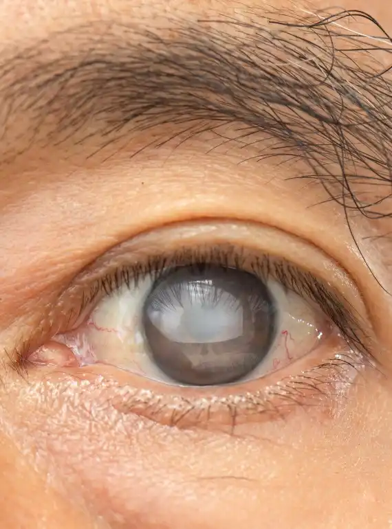 Especialistas en Glaucoma en Guadalajara