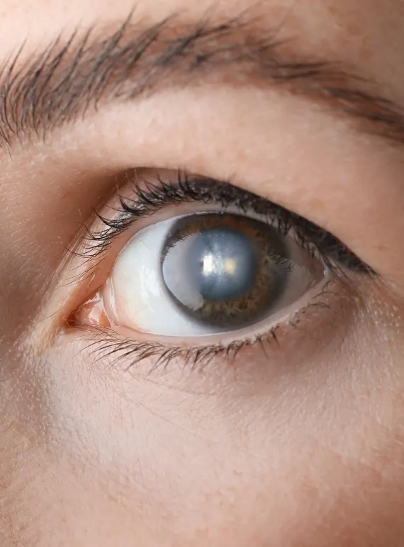 Especialistas en Glaucoma en Guadalajara