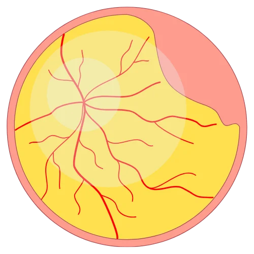 desprendimiento de retina Cirugía por Desprendimiento de Retina en Guadalajara