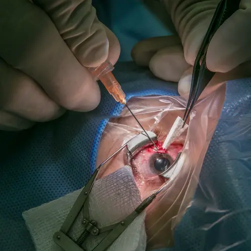 Cirugía de Cataratas en Guadalajara